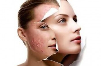 anti-acne-fisest