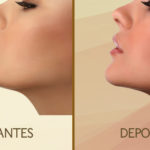 criolipolise-para-eliminar-a-papada-Fisest