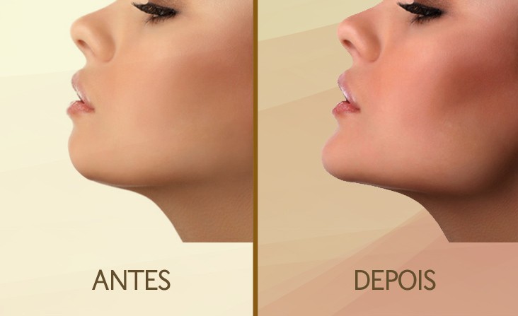 criolipolise-para-eliminar-a-papada-Fisest